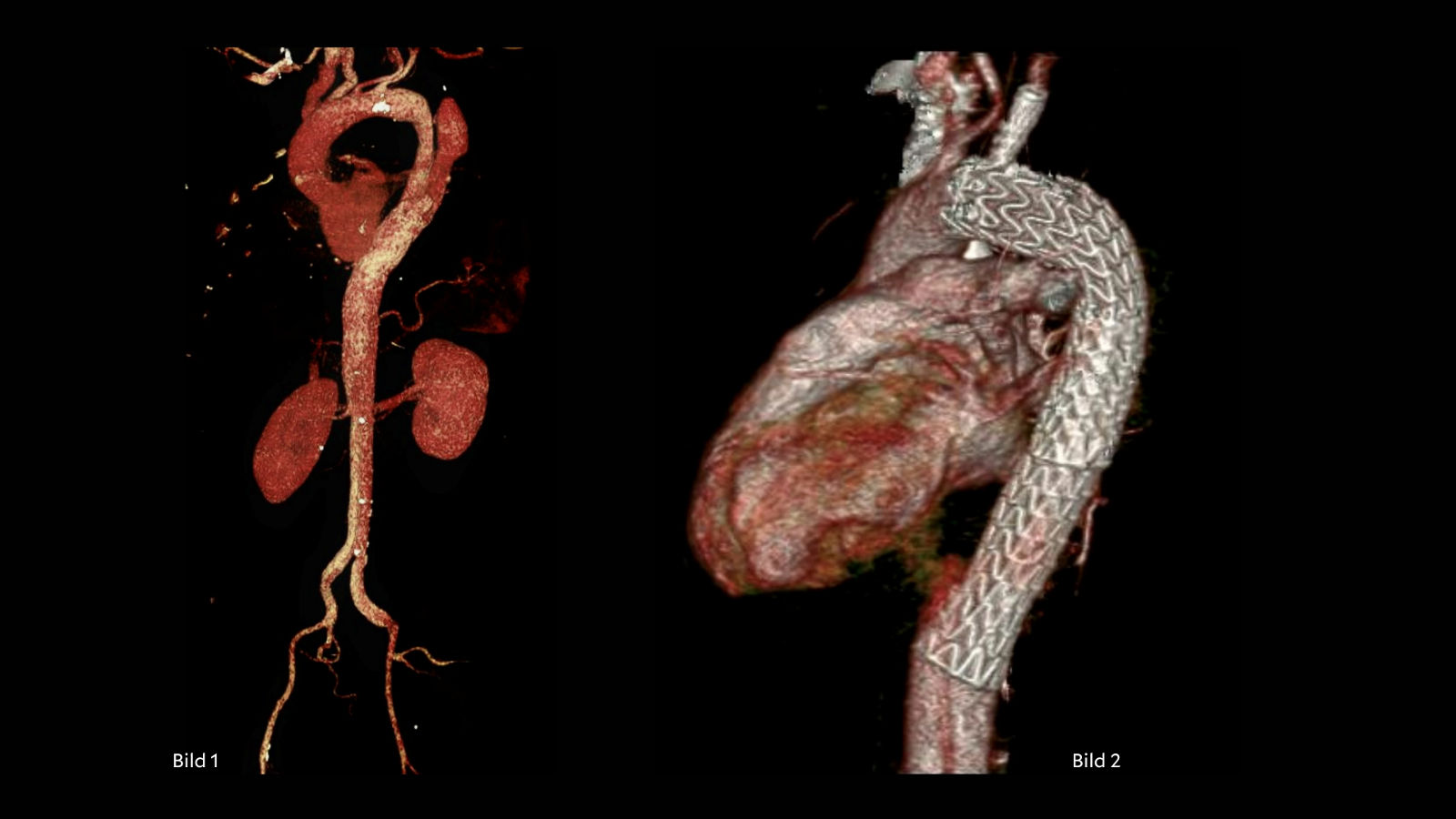 Helios Hospital Erfurt: First aortic stent with side arm implanted in Thuringia
